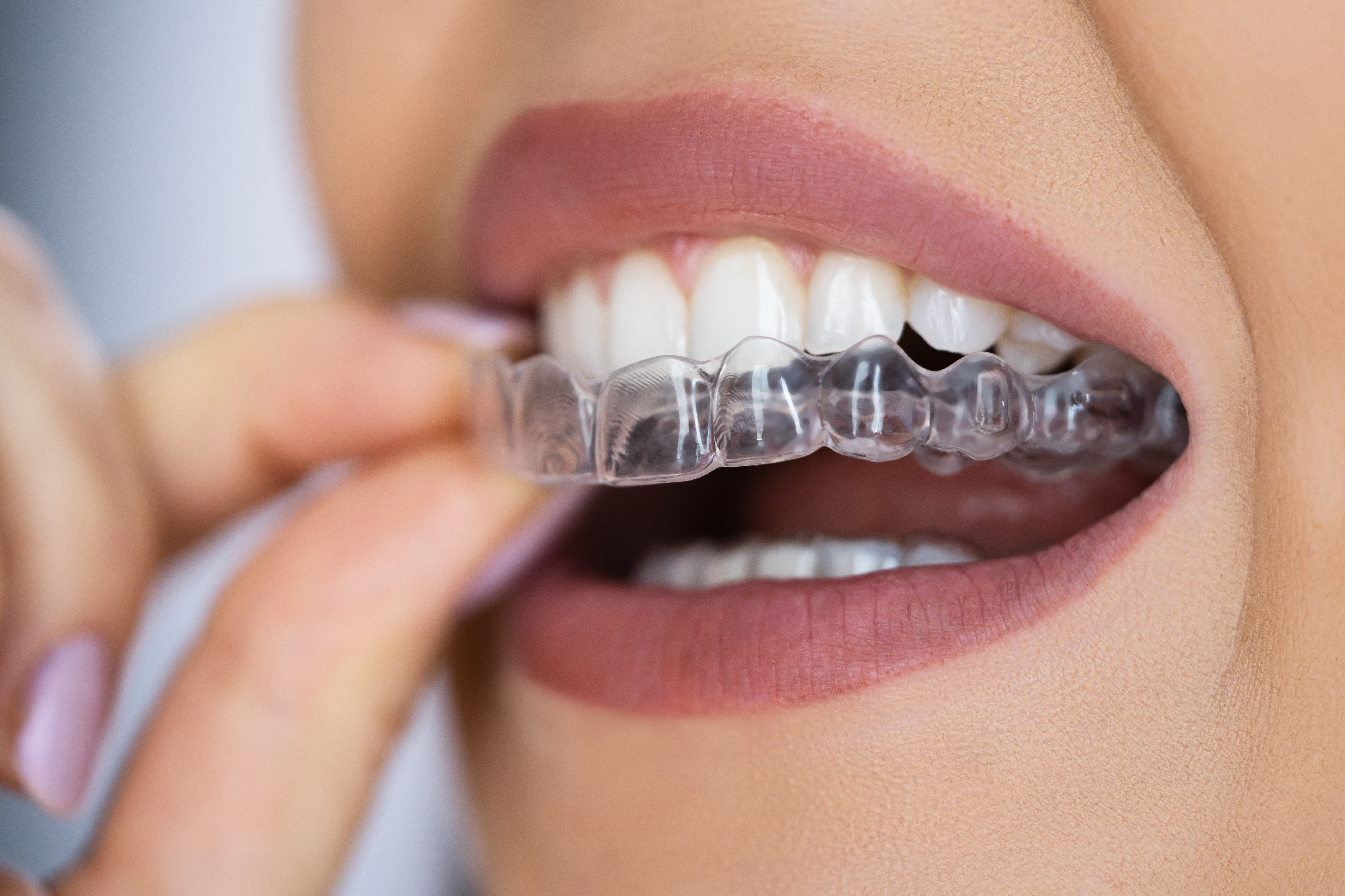 cosmetic dentist Invisalign